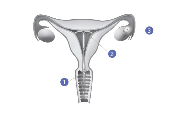 Snittegning af skede, livmoder og -hals med indsat hormonspiral