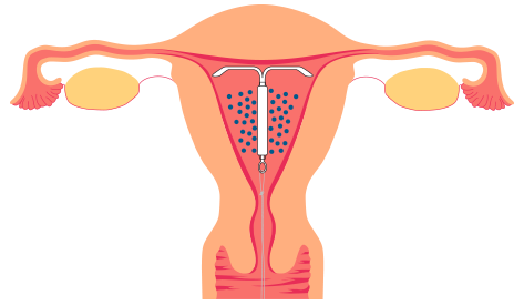 Snittegning af livmoder med hormonspiral